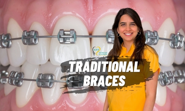 Traditional Braces for Complex Orthodontic Needs