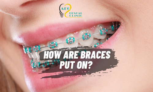 How Are Braces Put On?