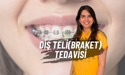 Diş Teli Tedavisi