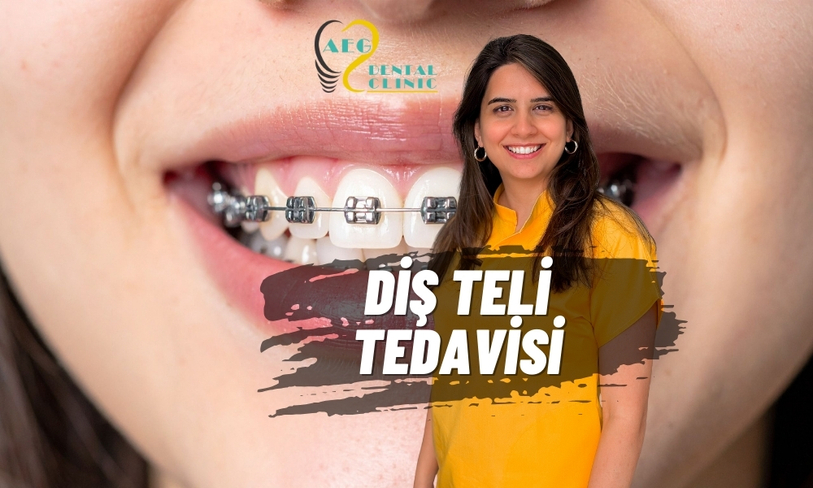 Geleneksel Güç: Metal ve Porselen Diş Teli Tedavisi