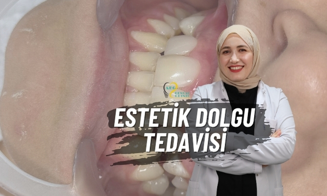 Estetik Dolgu – Çürük Dişlerde Estetik Çözüm