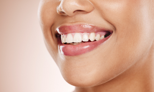 At-Home Teeth Whitening