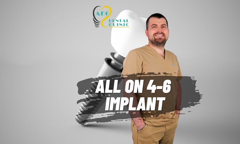 Fixed Teeth for Edentulous Jaws: All-on-4 and All-on-6