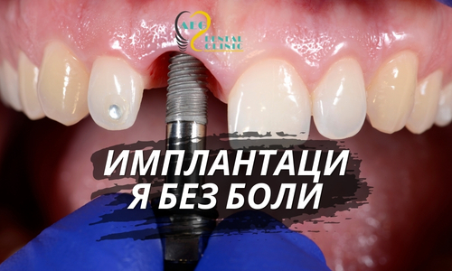 Имплантация зубов в Стамбуле