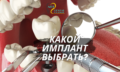 Имплантация зубов