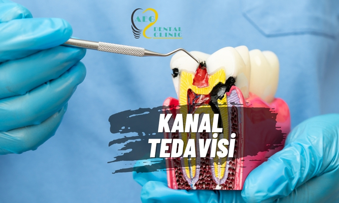 KANAL TEDAVİSİ (ENDODONTİ)