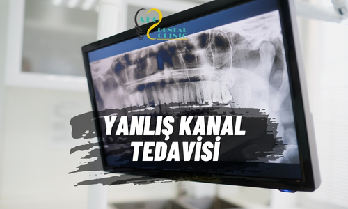 Kanal Tedavisi Pişmanlık Olmasın
