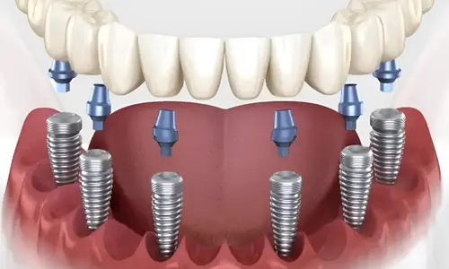 Полная имплантация зубов