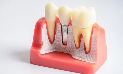 Одноимплантное лечение зуба