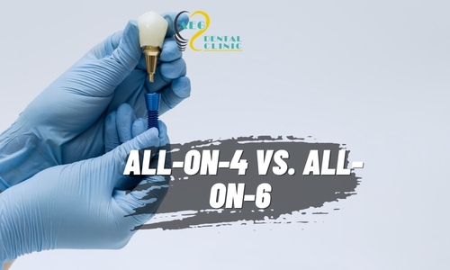 All-on-4 / 6 Guide